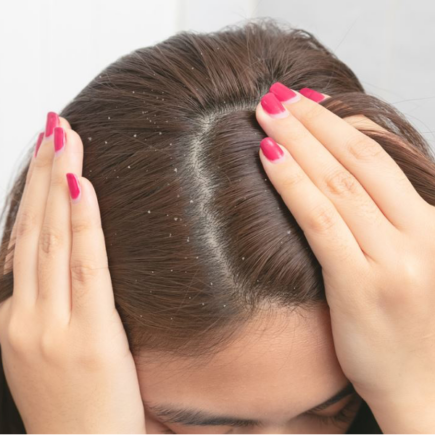 Pellicules et cheveux : comment se débarrasser des pellicules ?